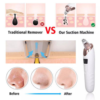 5-in-1 Portable Electric Blackhead Suction Device with 5 T9O8