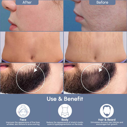Hair Renewal Roller – 1200 Microneedles for Scalp & Beard Growth