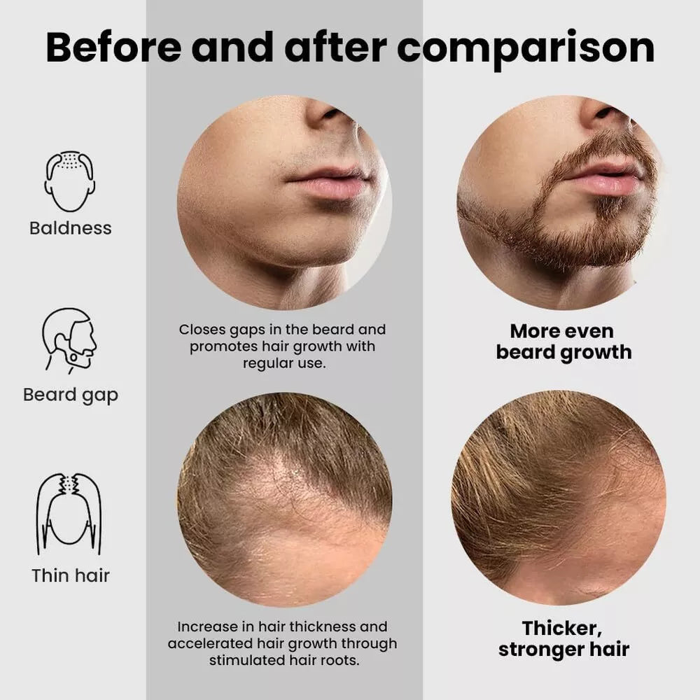 Hair Renewal Roller – 1200 Microneedles for Scalp & Beard Growth