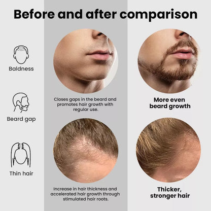 Hair Renewal Roller – 1200 Microneedles for Scalp & Beard Growth